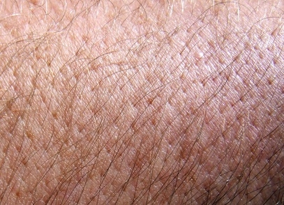 How to Remove Fiberglass From Skin