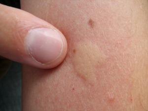 mosquito bits