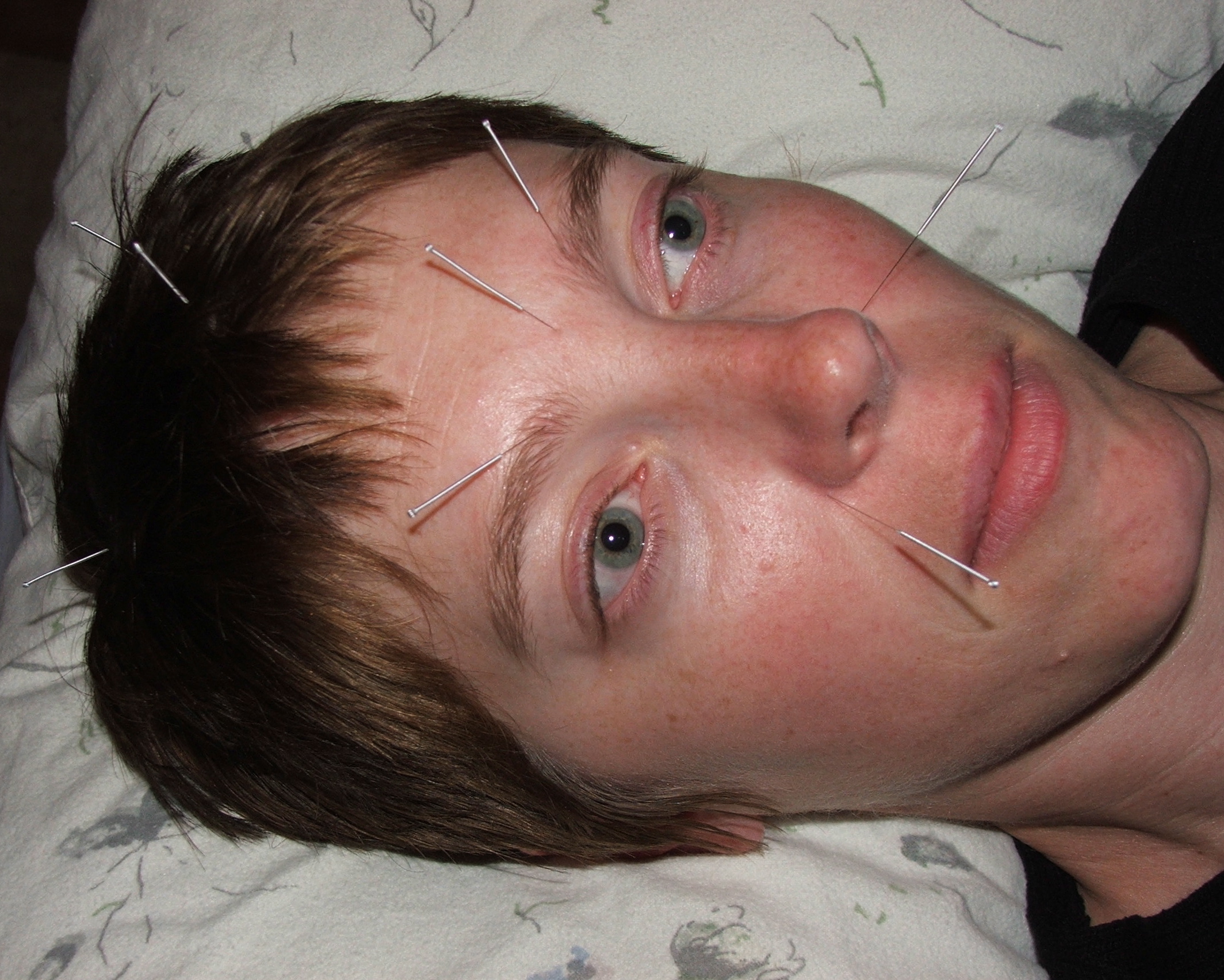 Facial_acupuncture